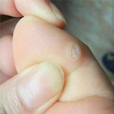 6 Pcs/Bag Foot Corn Remover Plaster Feet Callus Removal Detox Patch Health Care