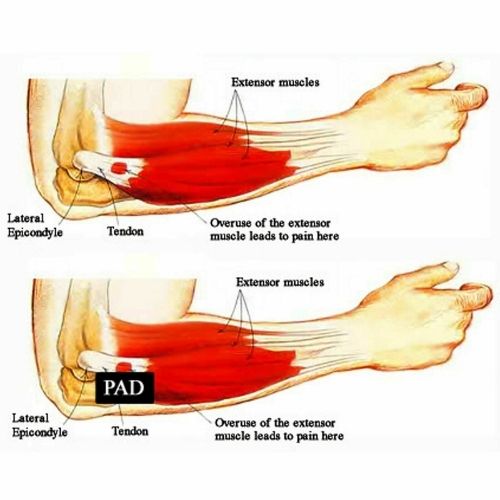 Tennis Elbow Brace Strap Tendonitis Golfers Gel Band Golf Pain Relief Support