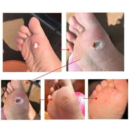 Corn Foot Patch Plantar Thorn Remove Foot Corn Removal Plaster Soften Skin CA