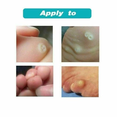 Corn Foot Patch Plantar Thorn Remove Foot Corn Removal Plaster Soften Skin CA