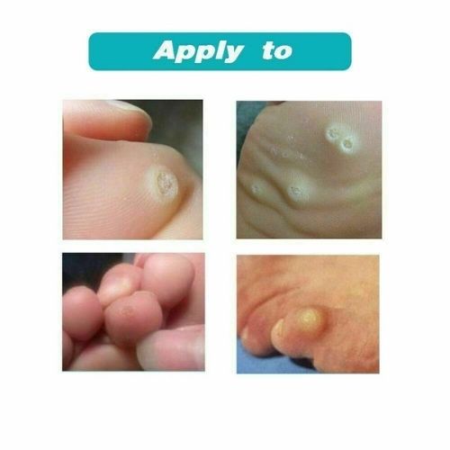 Corn Foot Patch Plantar Thorn Remove Foot Corn Removal Plaster Soften Skin CA